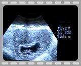 ultrasounds at 8 weeks. See more ultrasound at 8 weeks
